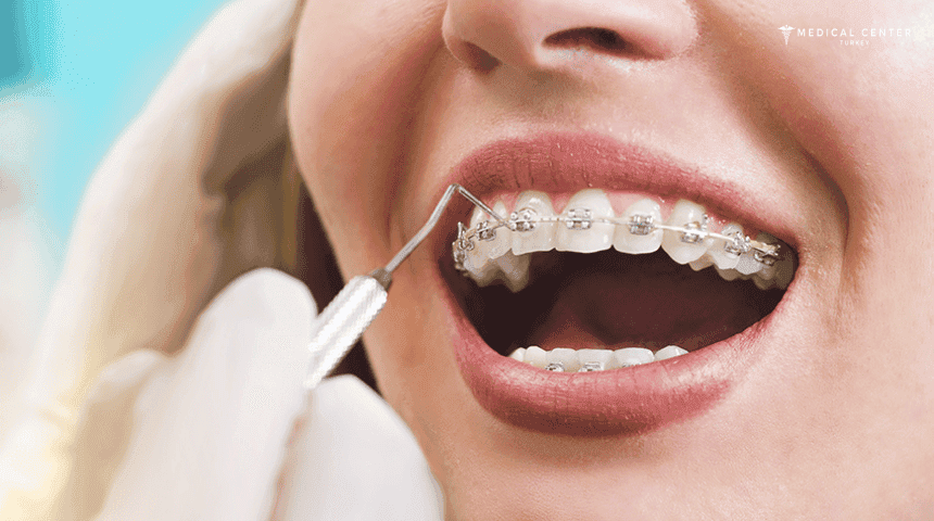 Orthodontic Treatments in Turkey