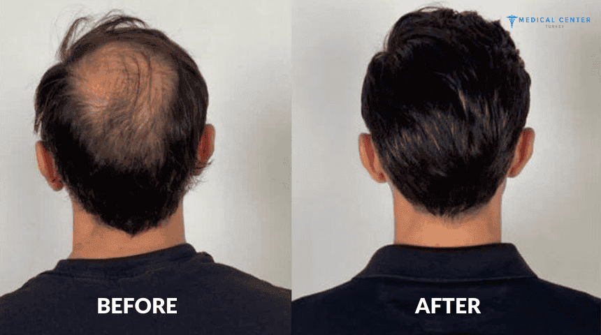 Paul's Hair Transplant Experience in Turkey
