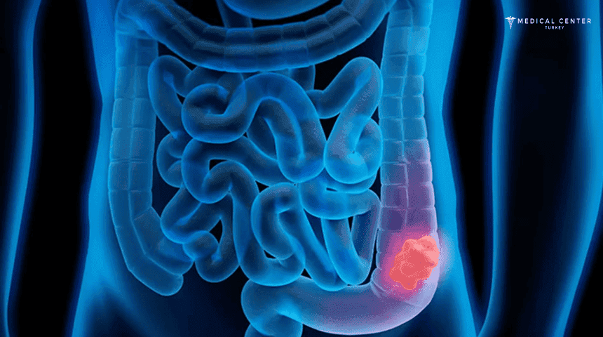 Rectal Cancer