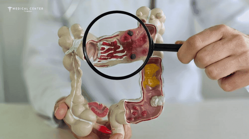 Removal of Colon Cancer