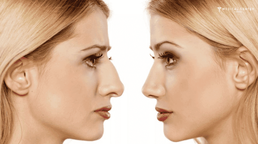 Rhinoplast (Nose Job) Before and After Turkey