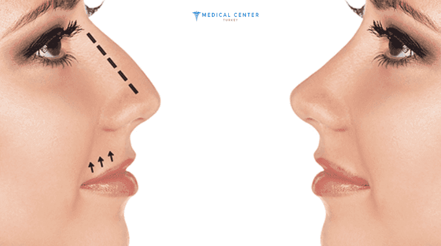 Rhinoplasty Cost in Turkey