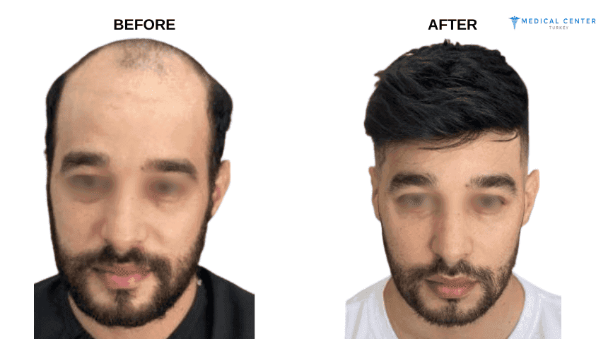 Roman’s Hair Transplant Experiences in Turkey