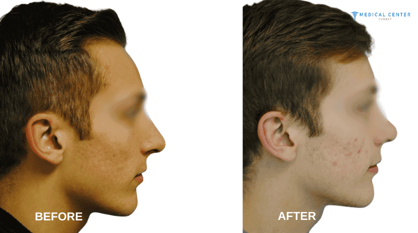 Sean's Rhinoplasty Experiences in Turkey