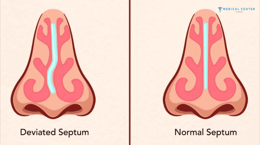 Septoplasty Cost in Turkey
