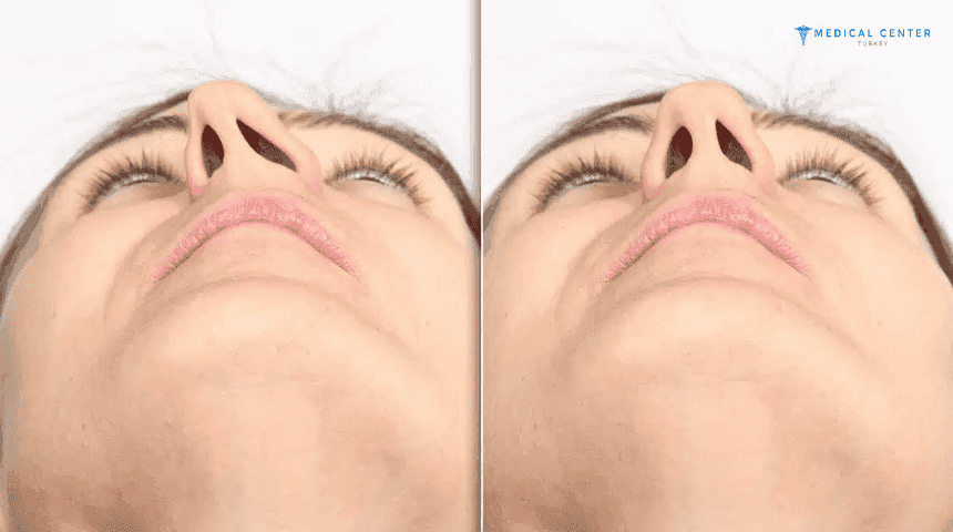 Septoplasty in Turkey