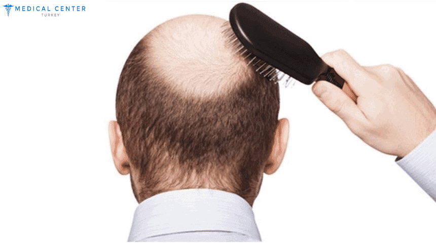 Shock Loss After Hair Transplant