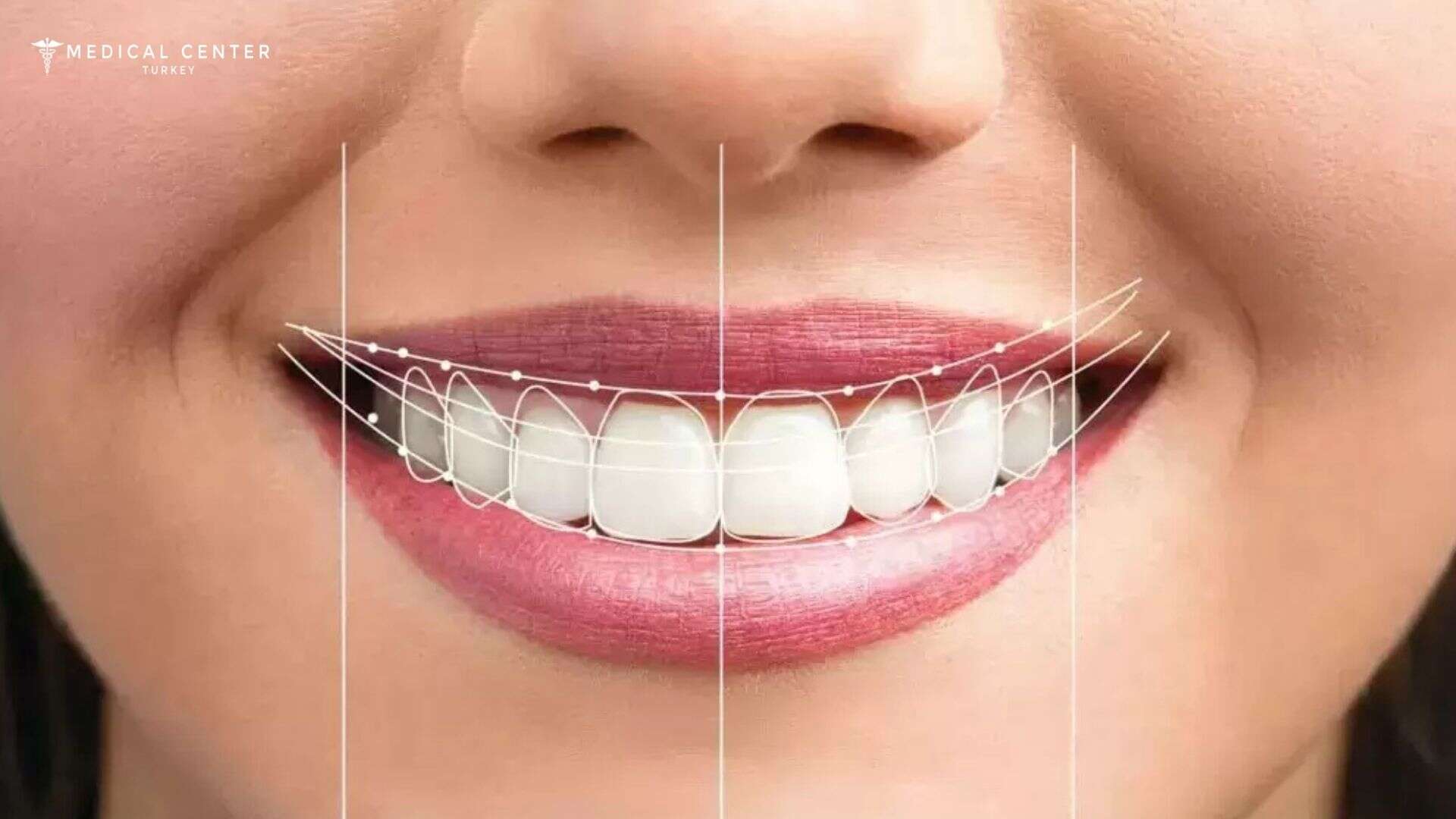 Smile Makeover Cost in Turkey