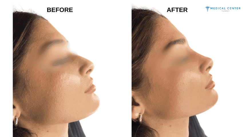 Sophia’s Rhinoplasty Experiences in Turkey