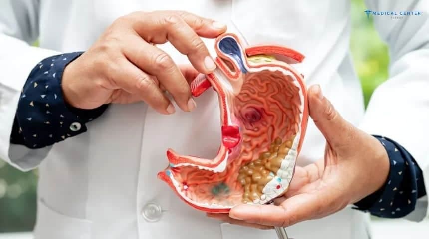 Stomach Cancer Stage 2
