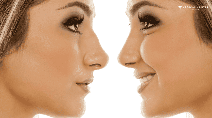 The Benefits of Non-Invasive Rhinoplasty in Turkey