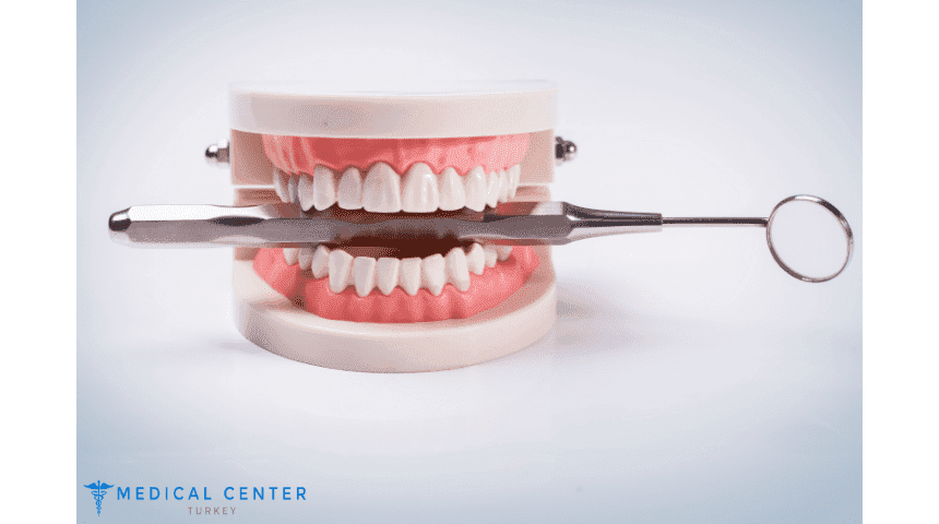 The Complete Guide to Veneers in Turkey