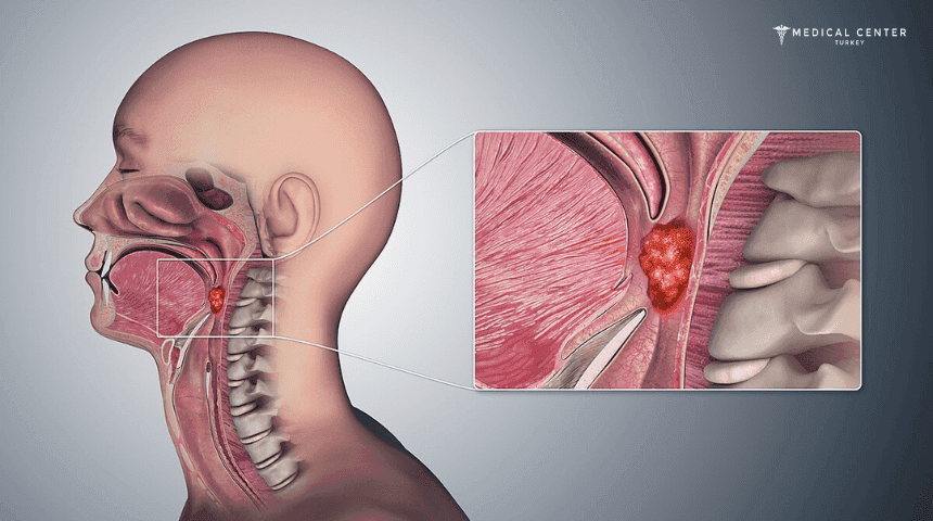Throat Cancer