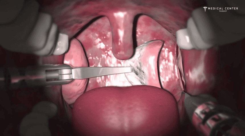 Throat Cancer Operation