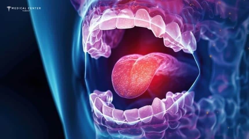 Tongue Cancer in Turkey
