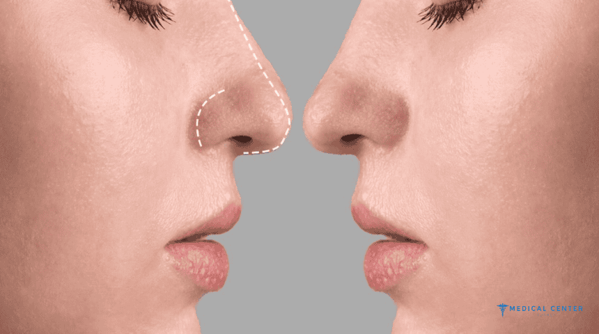 Top 5 Cheapest Countries for Rhinoplasty (Nose Job) in the World
