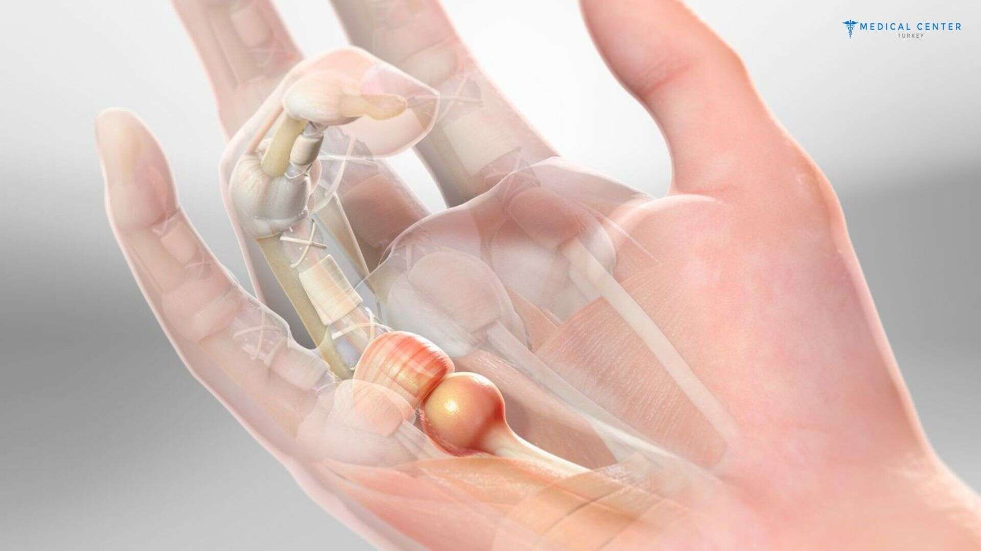Trigger Finger Correction in Turkey