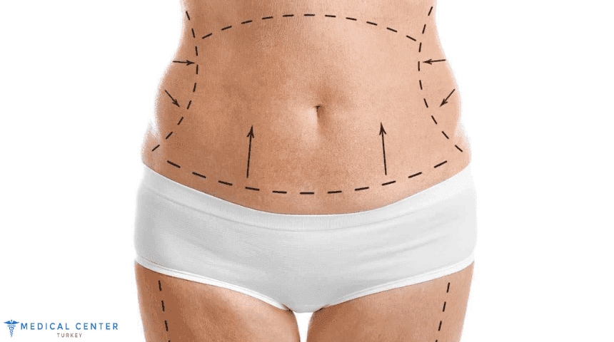 Tummy Tuck in Turkey