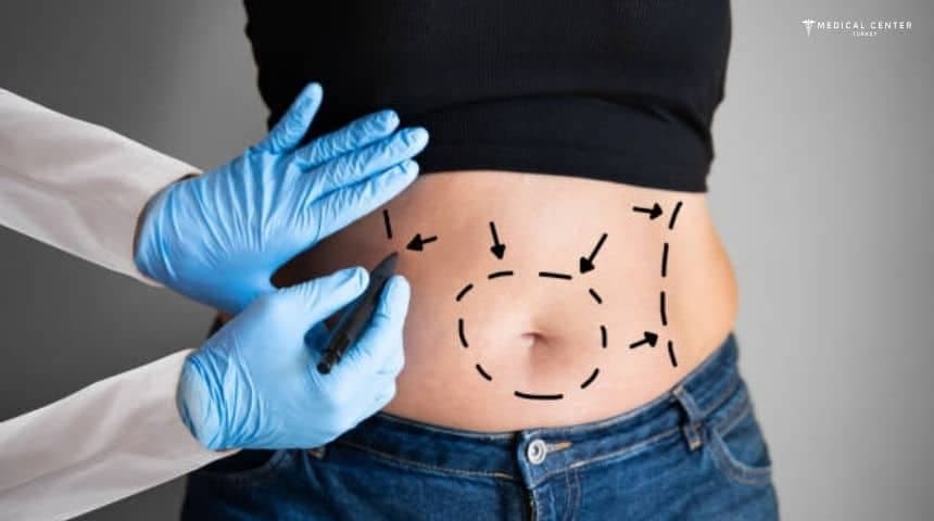 Tummy Tuck Journey Step by Step Experience