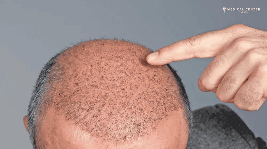 Turkey Hair Transplant FUE
