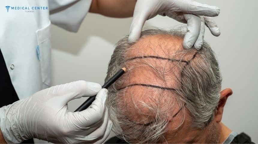 Understanding the Different Types of Hair Transplants and Which One Is Best?