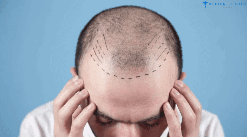 Unshaven and Painless Hair Transplantation