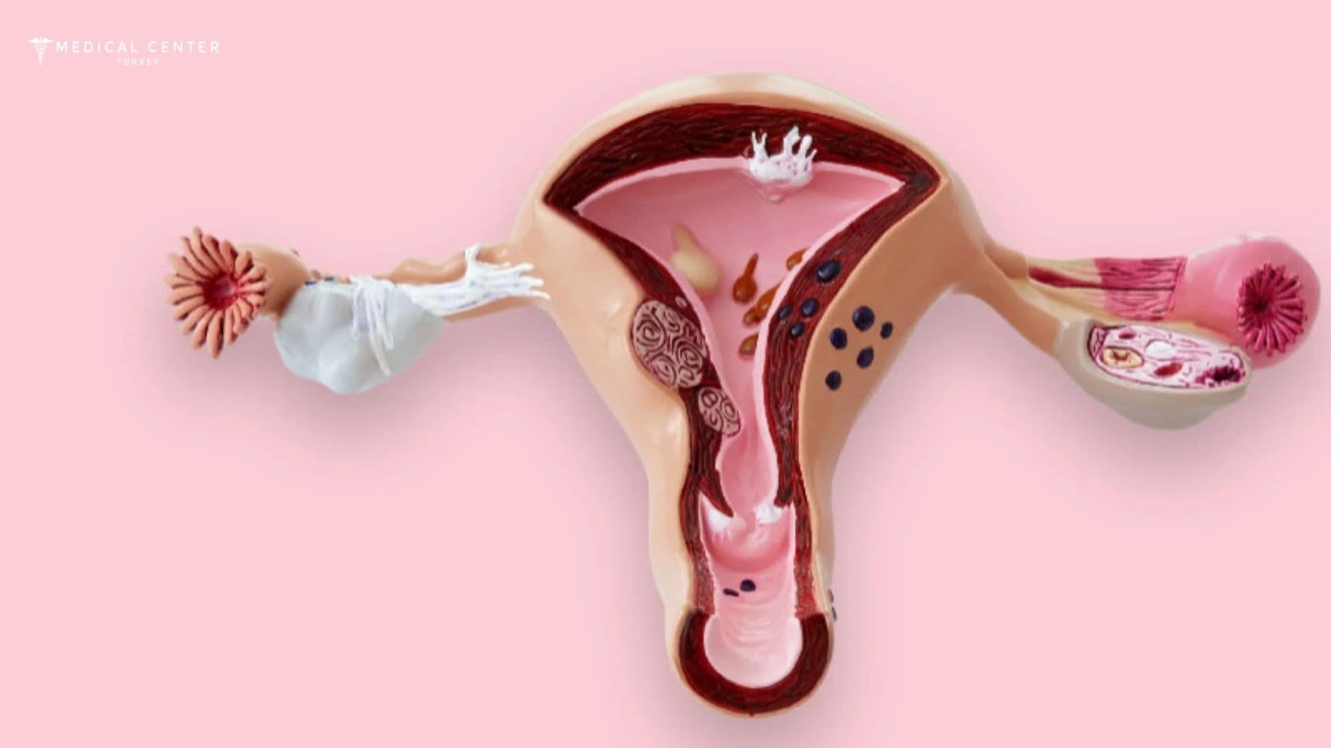 Vaginal Cancer