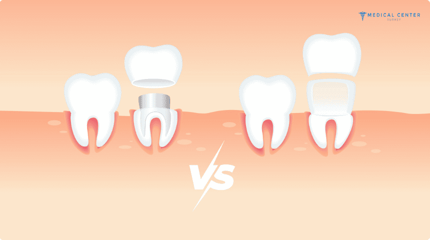 Veneers vs. Crowns: A Guide to Choosing the Best Option in Turkey
