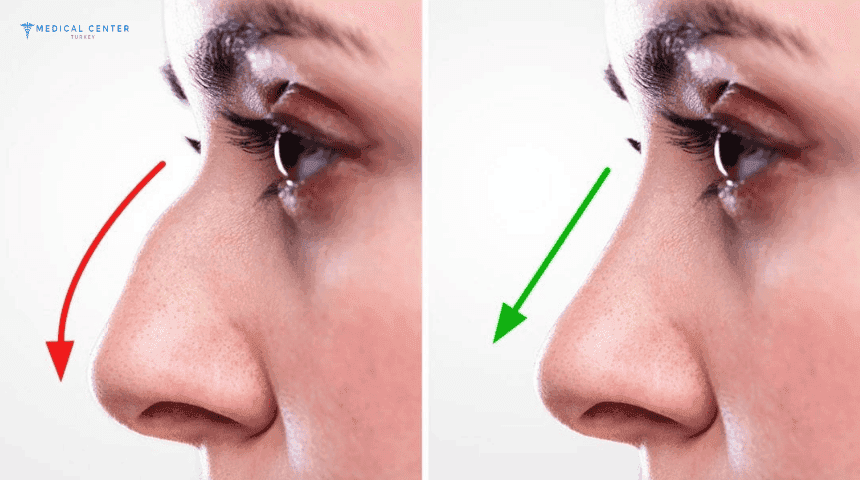 What Are the Differences Between Rhinoplasty Options in Turkey?