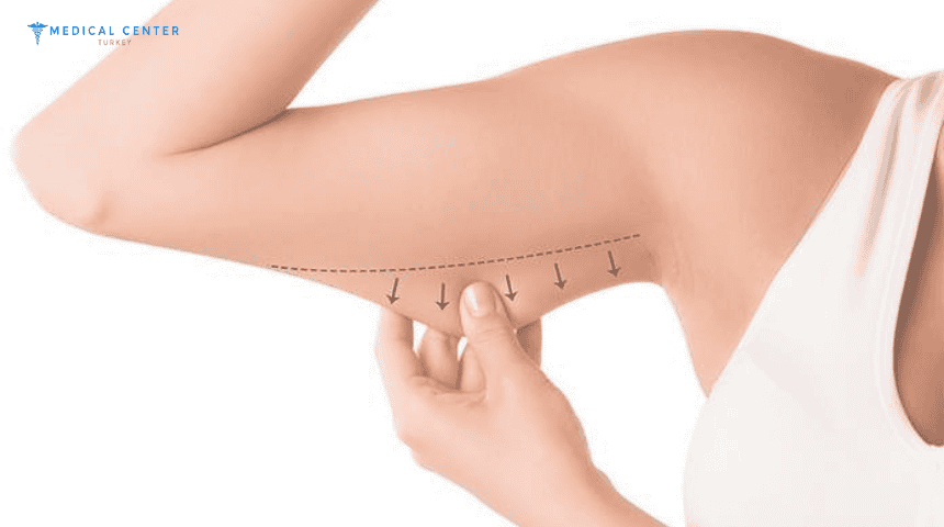 What Are the Expected Results of an Arm Lift in Turkey?