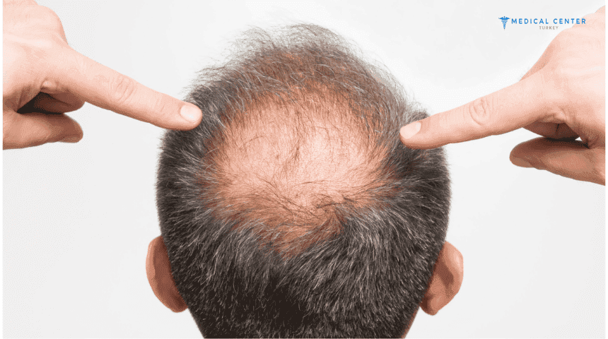 What are the Treatment Options for Baldness?