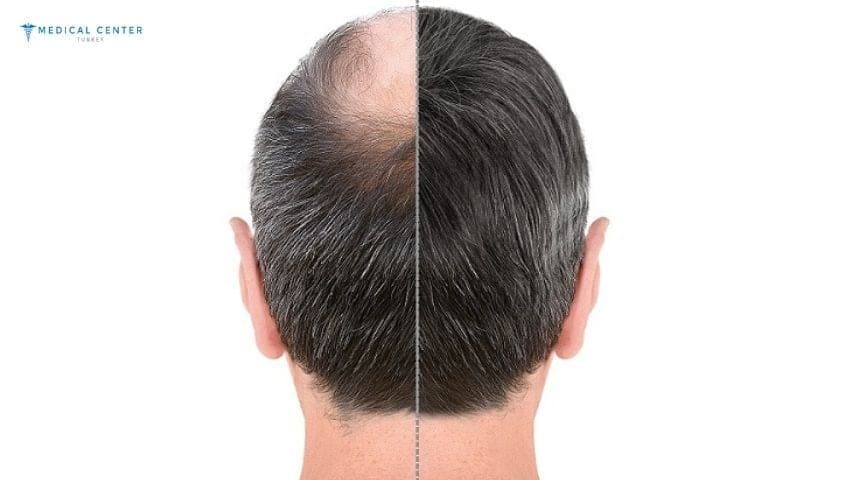 What is New in Hair Transplants?