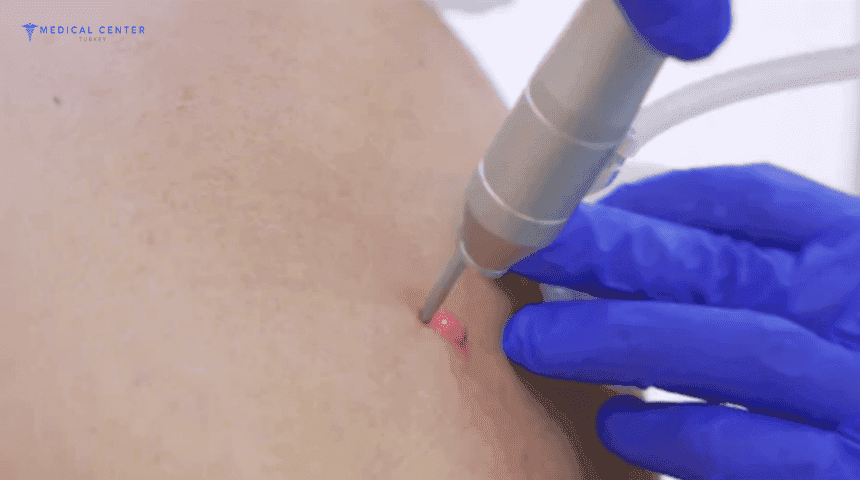 What is the cost of mole removal in Turkey?