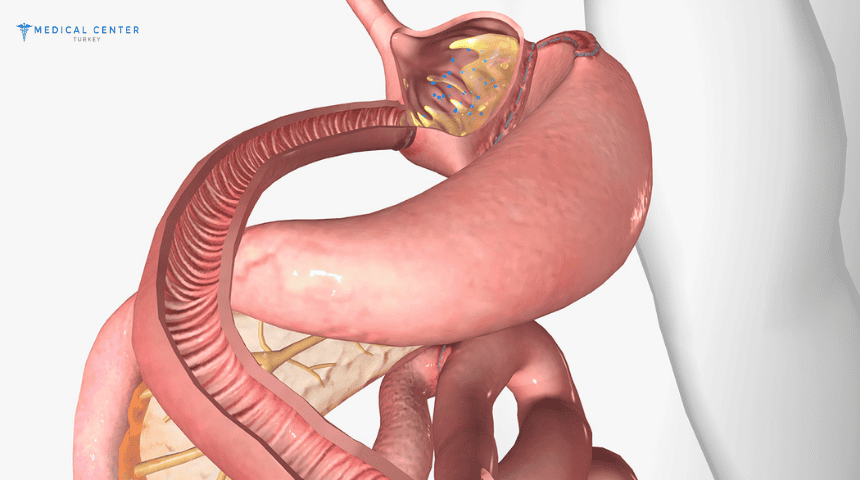 What is the Price of a Gastric Bypass in Turkey?
