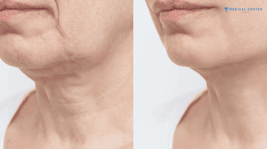 What Long Term Result Should You Expected Before and After Neck Lift?