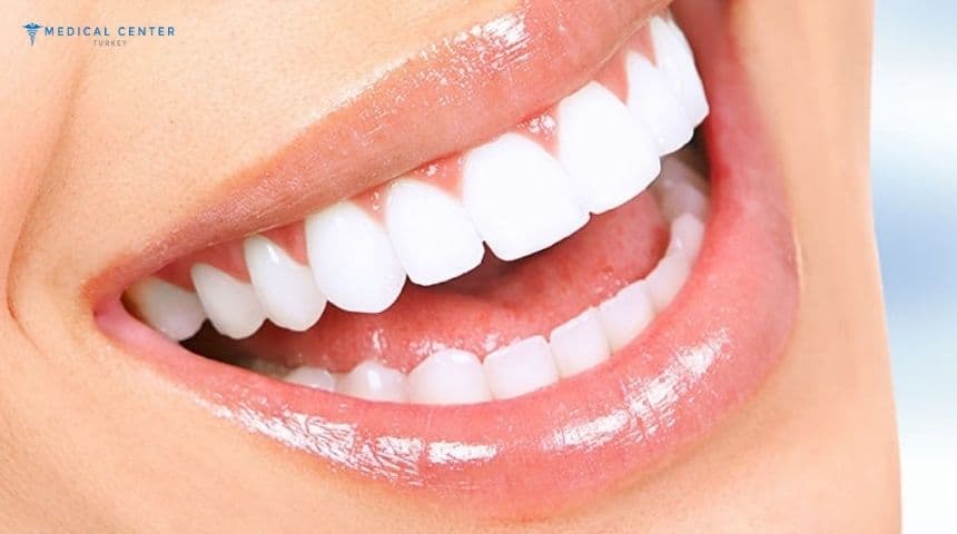 What You Need to Know About Dental Veneers in Turkey
