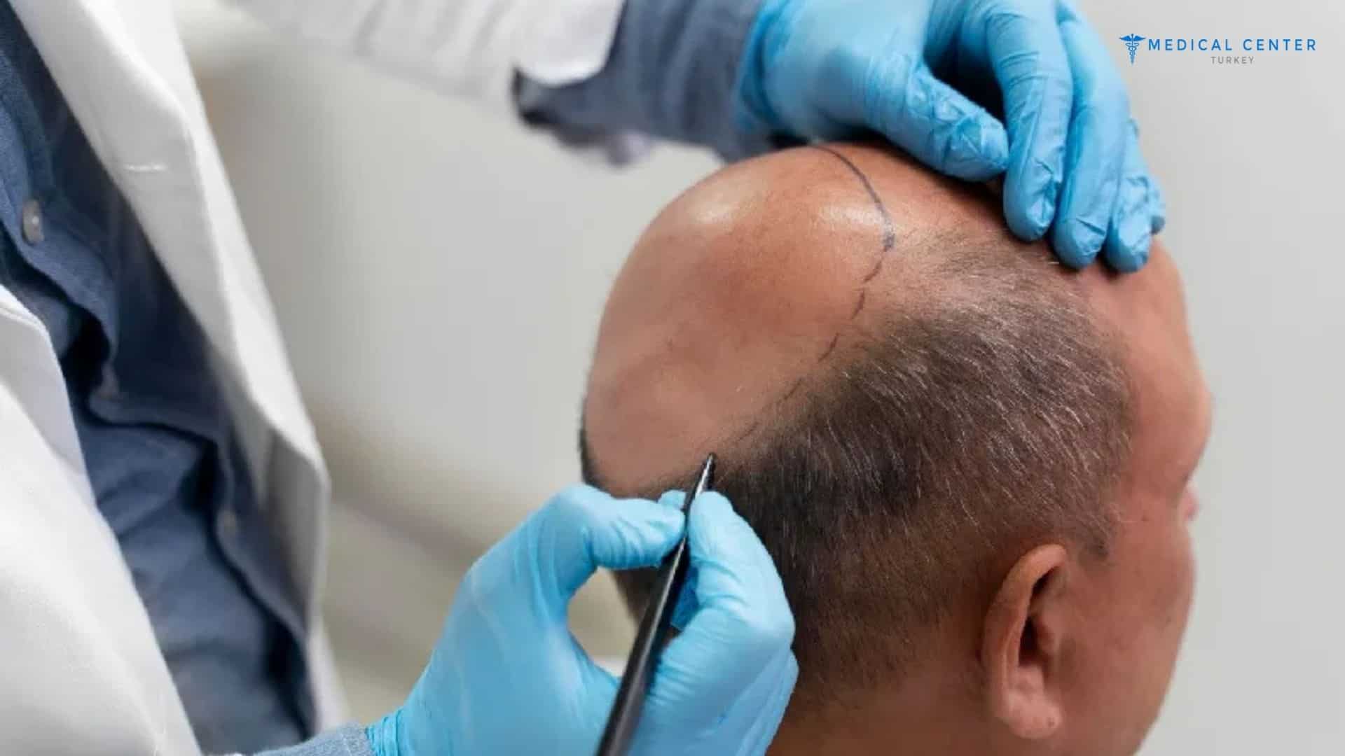 When Will You See Results After a Hair Transplant?
