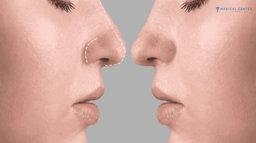 When Will You See the Shape of Your Nose After Rhinoplasty?
