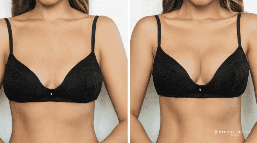 Why Choose Turkey for Breast Augmentation?