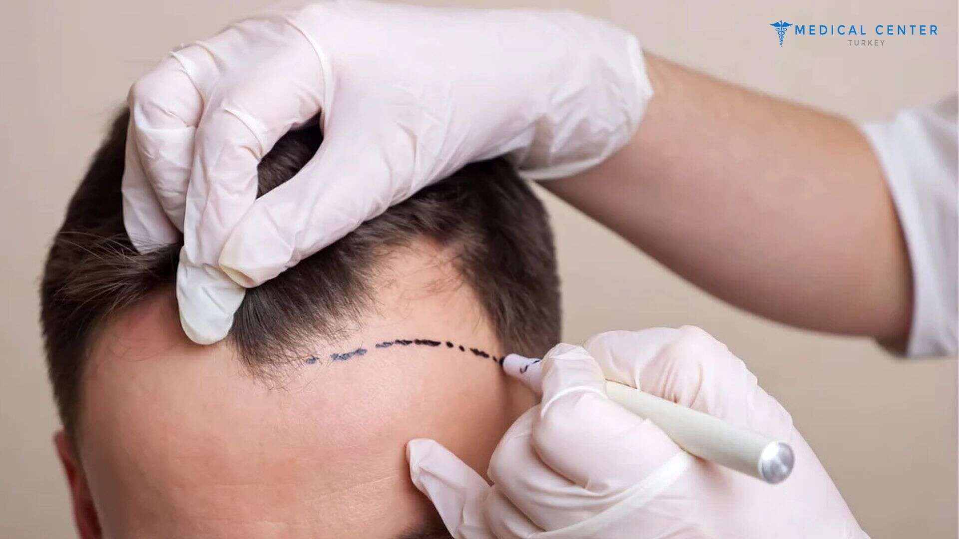 Why Do People Go to Turkey for Hair Transplant?
