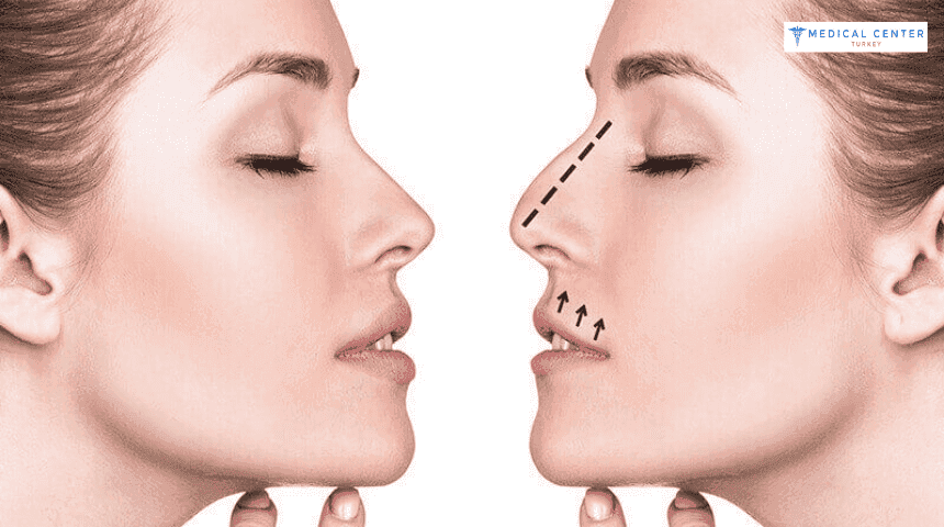Why is 2026 the Best Year to Get a Nose Job?