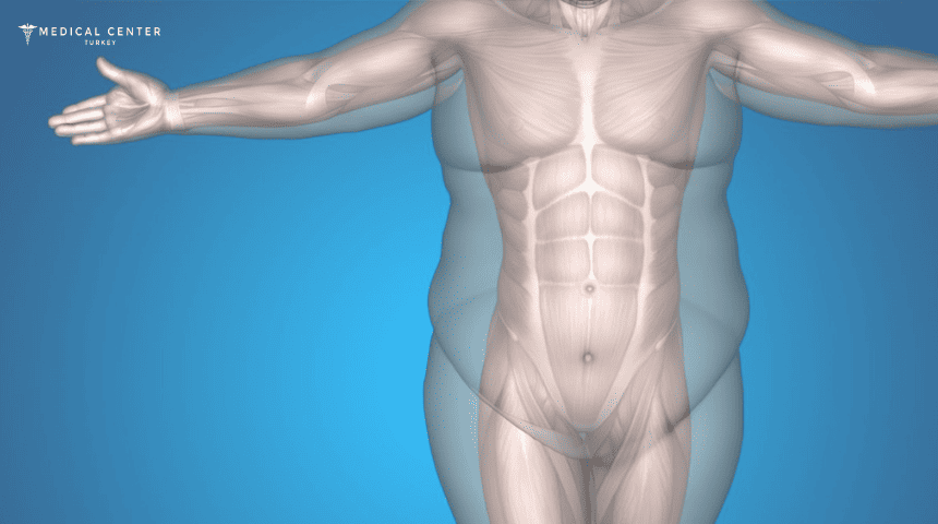 Why Is Everyone Talking About Liposuction in Turkey ?