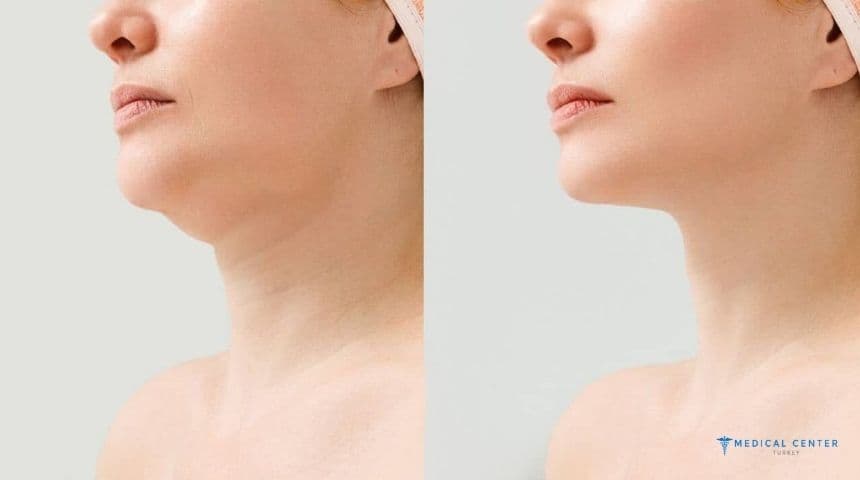 Why Jowl Liposuction is Gaining Popularity in Turkey?