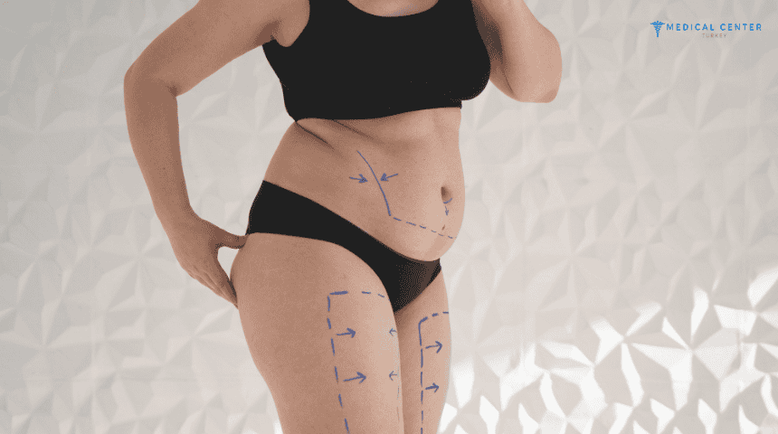 Why Liposuction in Turkey is the Best Option for You?