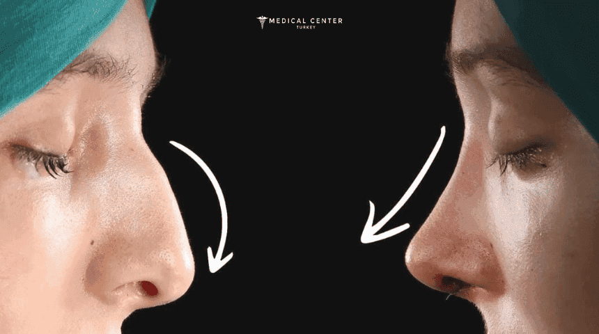 Why Turkish Rhinoplasty surgery Is So Popular?