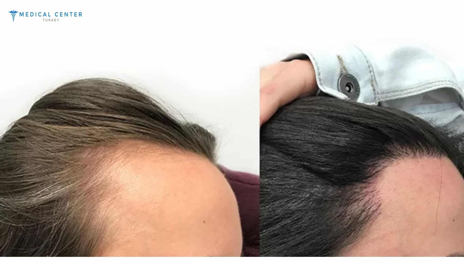 Zoe Hair Transplant Experince in Turkey