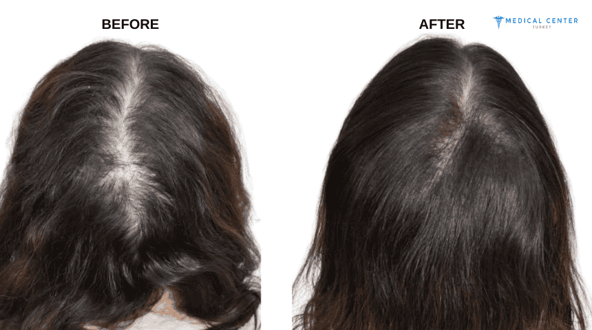 Zoya’s Hair Transplant Experiences in Turkey