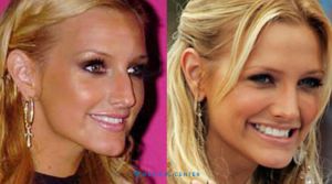 10 Celebrity Rhinoplasty Results