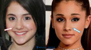 10 Celebrity Rhinoplasty Results