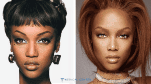10 Celebrity Rhinoplasty Results